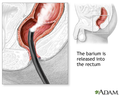 Barium enema Barium enema