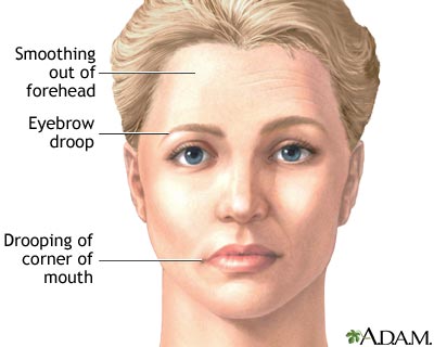 Facial drooping Facial drooping