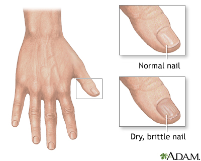 Brittle nails Brittle nails