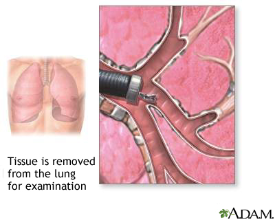 Bronchoscopic culture Bronchoscopic culture