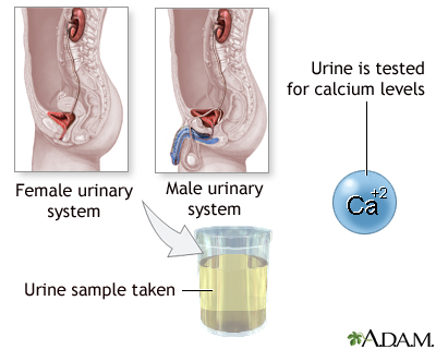 Calcium urine test Calcium urine test