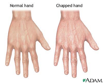 Chapped hands Chapped hands