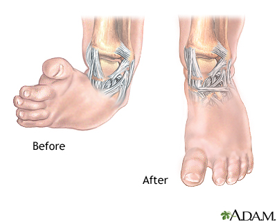 Clubfoot deformity Clubfoot deformity