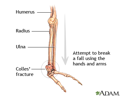Colles fracture Colles fracture