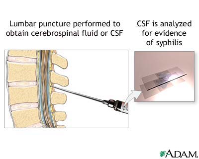 CSF test for syphilis CSF test for syphilis