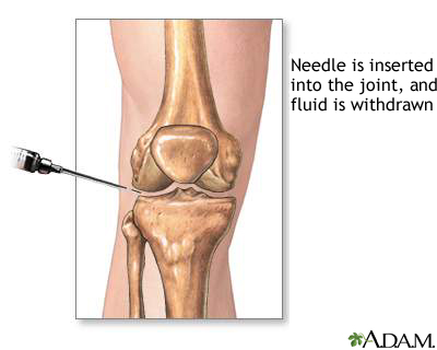 Joint aspiration Joint aspiration