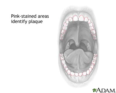 Dental plaque stain Dental plaque stain