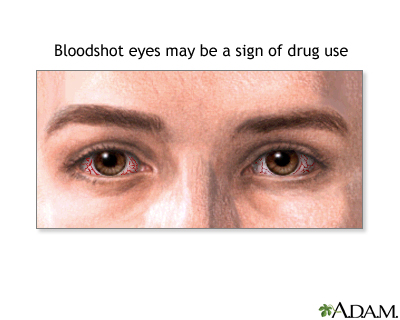 Signs of drug use Signs of drug use