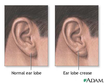 Ear lobe crease Ear lobe crease