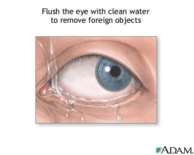Foreign objects in eye Foreign objects in eye