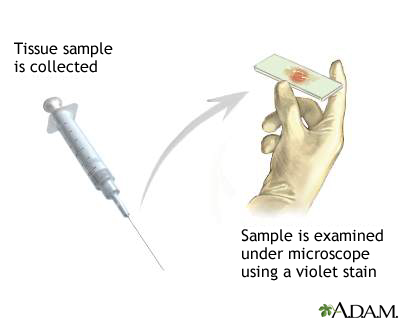 Gram stain of tissue biopsy Gram stain of tissue biopsy