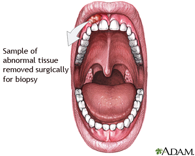 Gum biopsy Gum biopsy