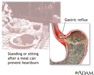 Heartburn prevention Heartburn prevention