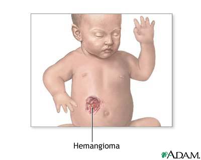 Hemangioma excision Hemangioma excision