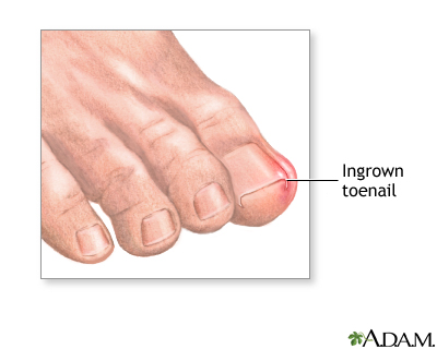 Ingrown toenail Ingrown toenail