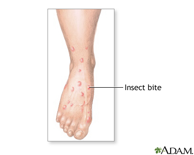 Insect bites and stings Insect bites and stings