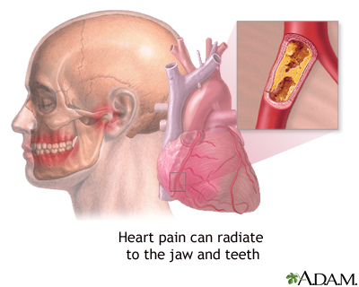 Jaw pain and heart attacks Jaw pain and heart attacks