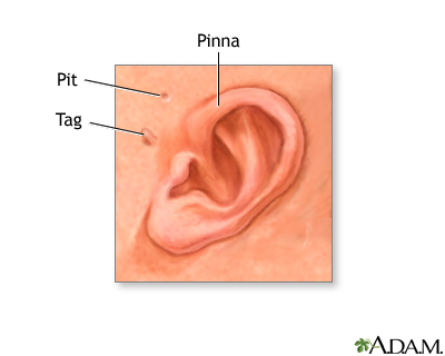 Newborn ear anatomy Newborn ear anatomy