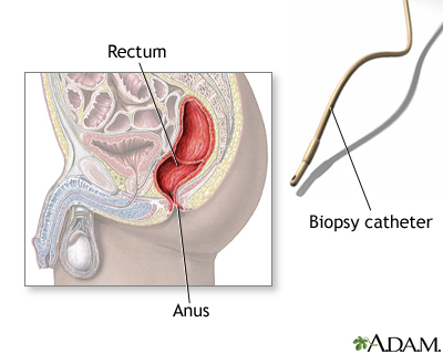 Rectal biopsy Rectal biopsy