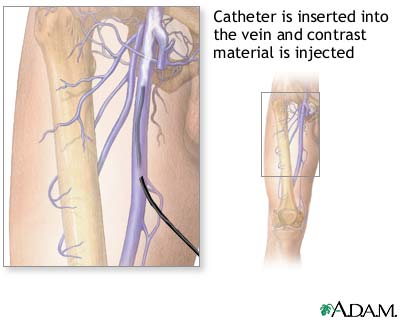Leg venography Leg venography