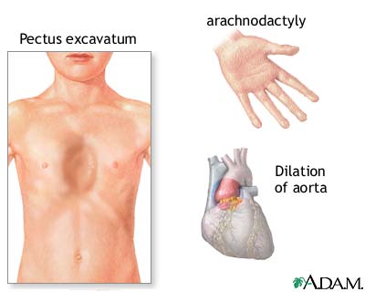 Marfan syndrome Marfan syndrome