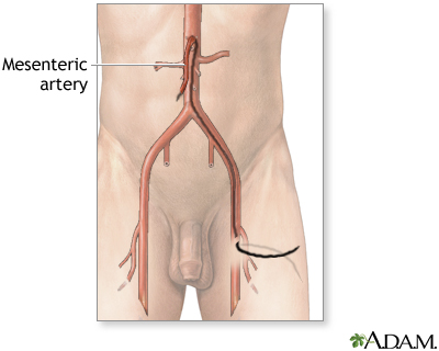 Mesenteric arteriography Mesenteric arteriography