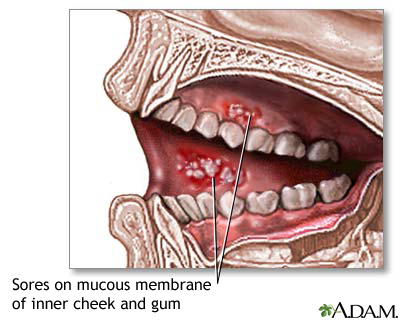 Mouth sores Mouth sores