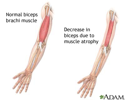 Muscular atrophy Muscular atrophy