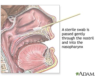 Nasopharyngeal culture