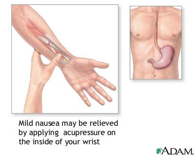 Nausea acupressure Nausea acupressure