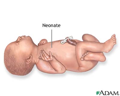 Neonate Neonate