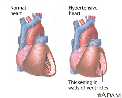 Hypertension Hypertension