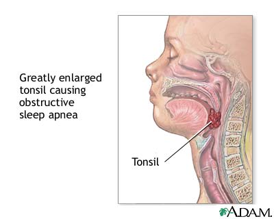 Obstructive sleep apnea Obstructive sleep apnea