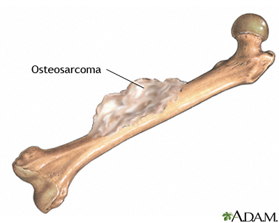 Bone tumor Bone tumor