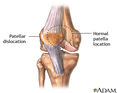 Patellar dislocation Patellar dislocation