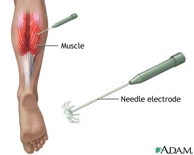 Electromyography Electromyography