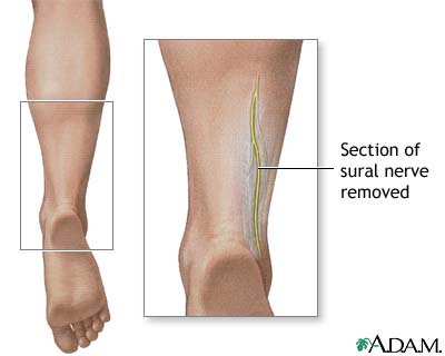 Nerve biopsy Nerve biopsy