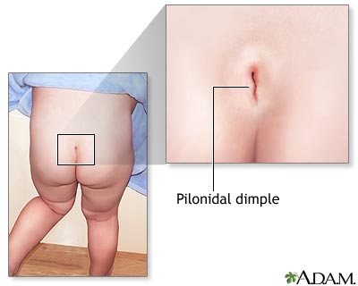 Pilonidal dimple Pilonidal dimple