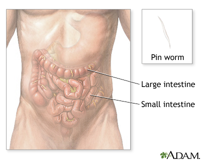 Pinworms Pinworms