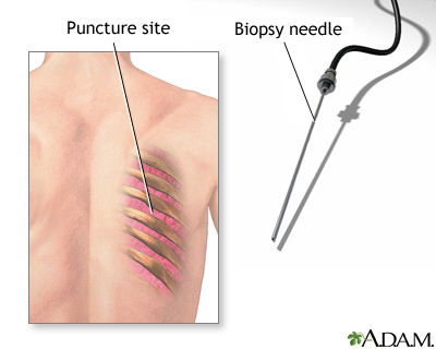 Lung biopsy Lung biopsy