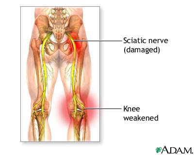Sciatic nerve damage Sciatic nerve damage