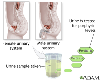 Porphyrin urine test Porphyrin urine test