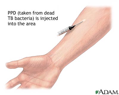 PPD skin test PPD skin test