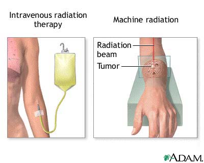 Radiation therapy Radiation therapy