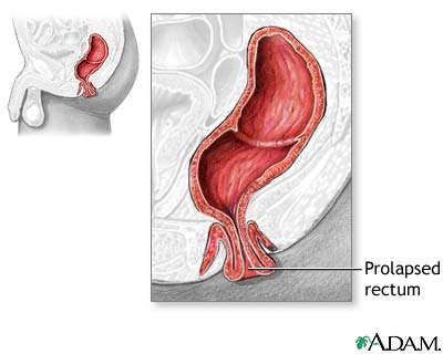 Rectal prolapse Rectal prolapse