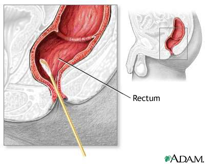 Rectal culture Rectal culture