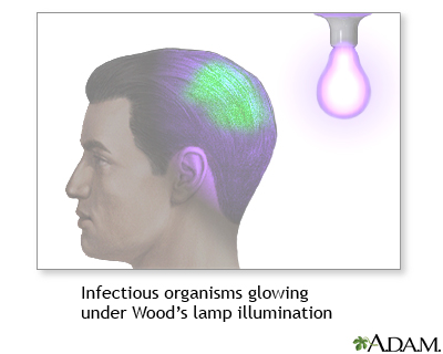 Wood's lamp illumination Wood's lamp illumination