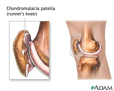 Runners knee Runners knee