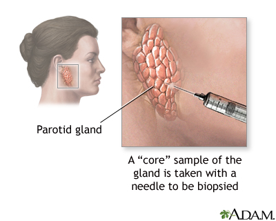 Salivary gland biopsy Salivary gland biopsy