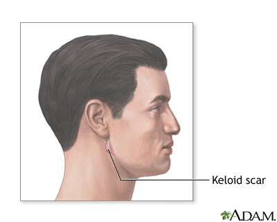 Keloid scar Keloid scar